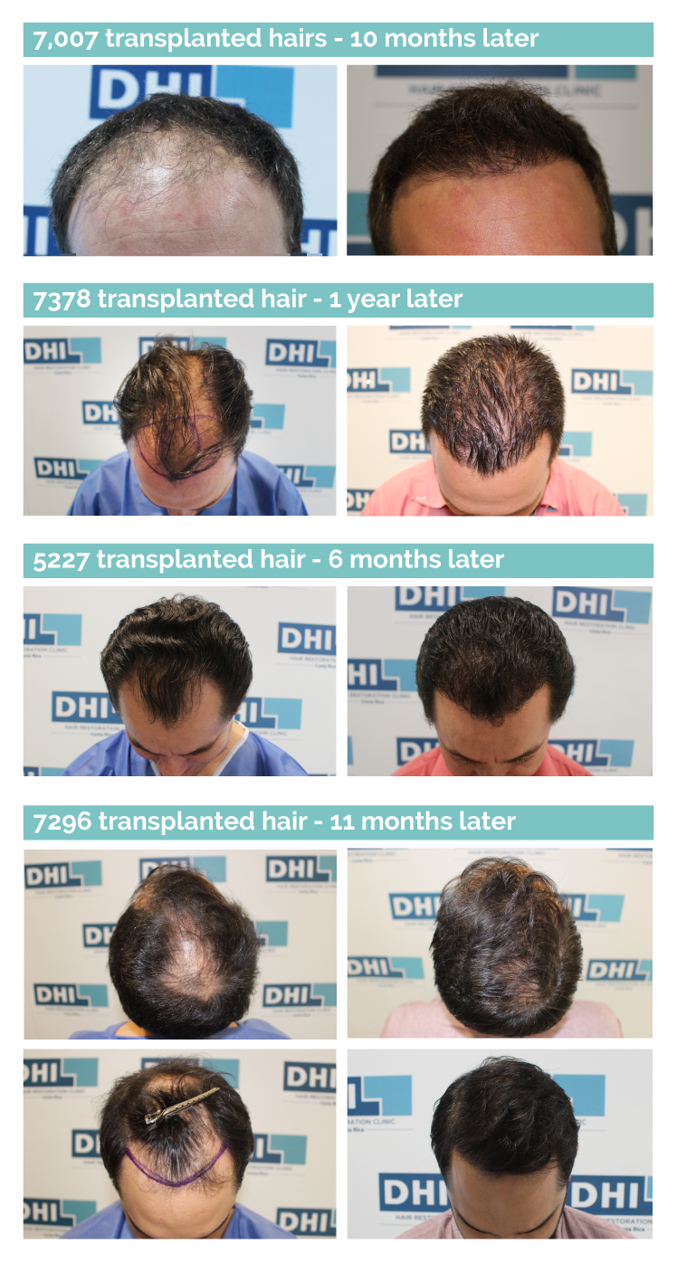 The DHI (direct hair implantation) procedure in Costa Rica