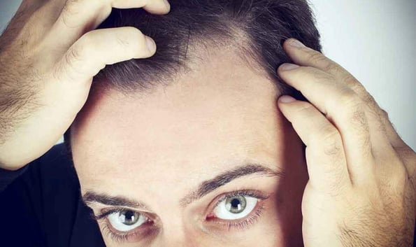 mens-hair-loss-norwood-scale-1170x695